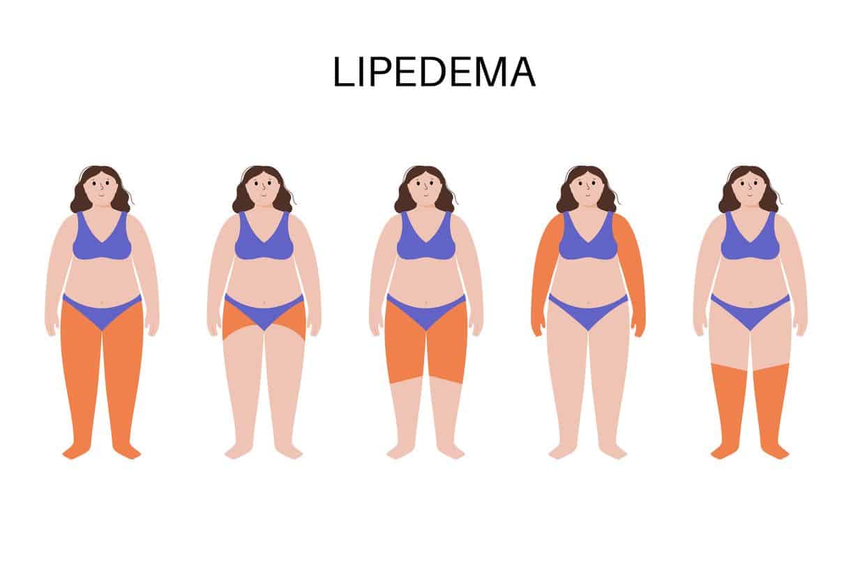 Lipedema: Desafíos Cotidianos de las Mujeres ante el Dolor y la Hinchazón 1 Silvia Pastor