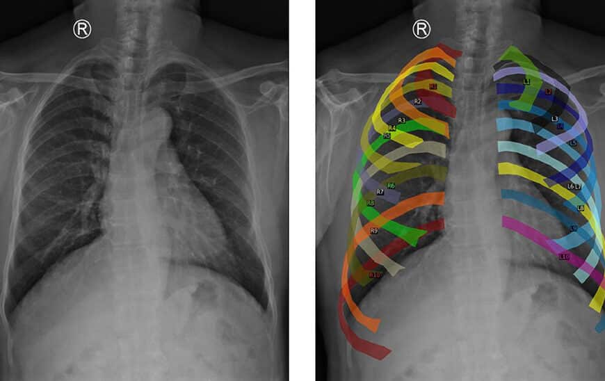Modelo Inteligente Andaluza: Avances en el Diagnóstico Temprano de Enfermedades Pulmonares