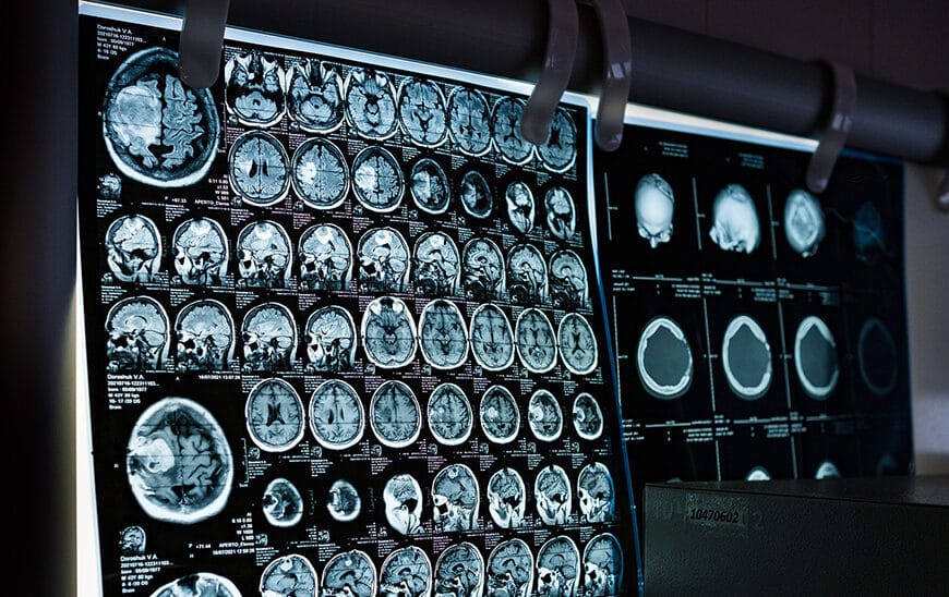 Andalucía Introduce la Terapia 'TTFields' para Tratar el Glioblastoma en Hospitales Públicos