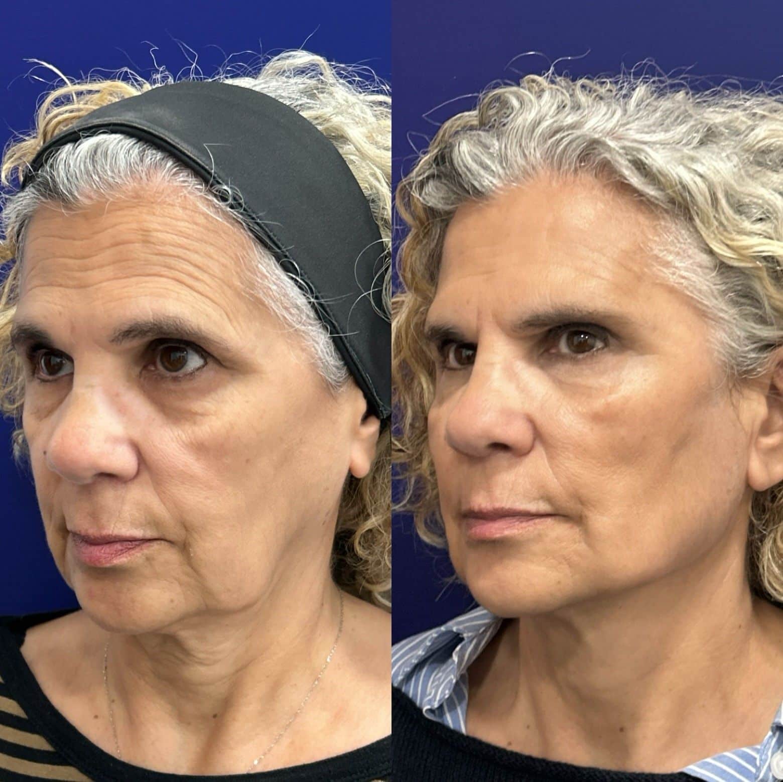 Revolución en el Rejuvenecimiento: Dr. Ángel Martín y el Protocolo Global Face para una Piel Más Firme y Elástica 1 Sergio Ramirez chef