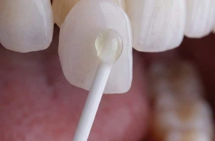 Instituto Volpe Revoluciona la Odontología Estética con el Lanzamiento de Skin Finea®: Carillas Ultradelgadas que Conservan el Diente al Máximo