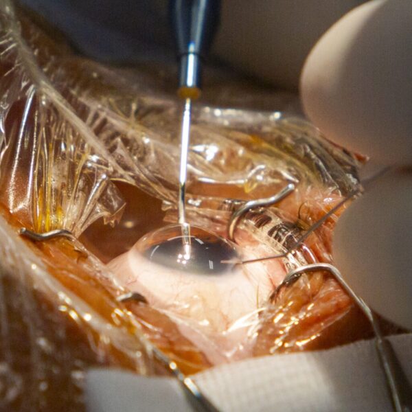 Codirector de FacoElche se Somete en Vivo a Innovadora Implantación Bilateral de Lentes AI