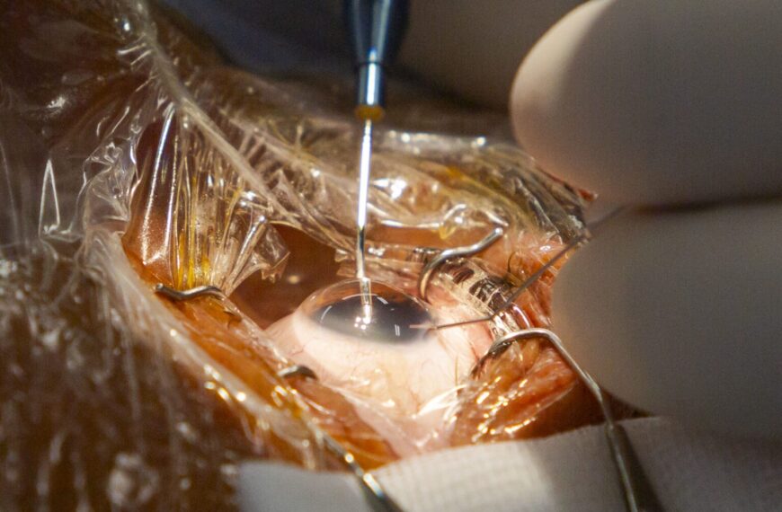 Codirector de FacoElche se Somete en Vivo a Innovadora Implantación Bilateral de Lentes AI