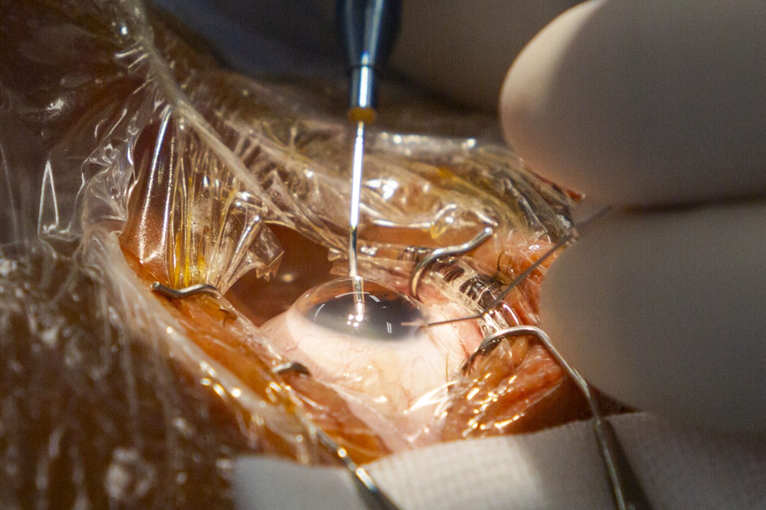 Codirector de FacoElche se Somete en Vivo a Innovadora Implantación Bilateral de Lentes AI 1 Codirector de FacoElche se Somete en Vivo a Innovadora Implantación Bilateral de Lentes AI